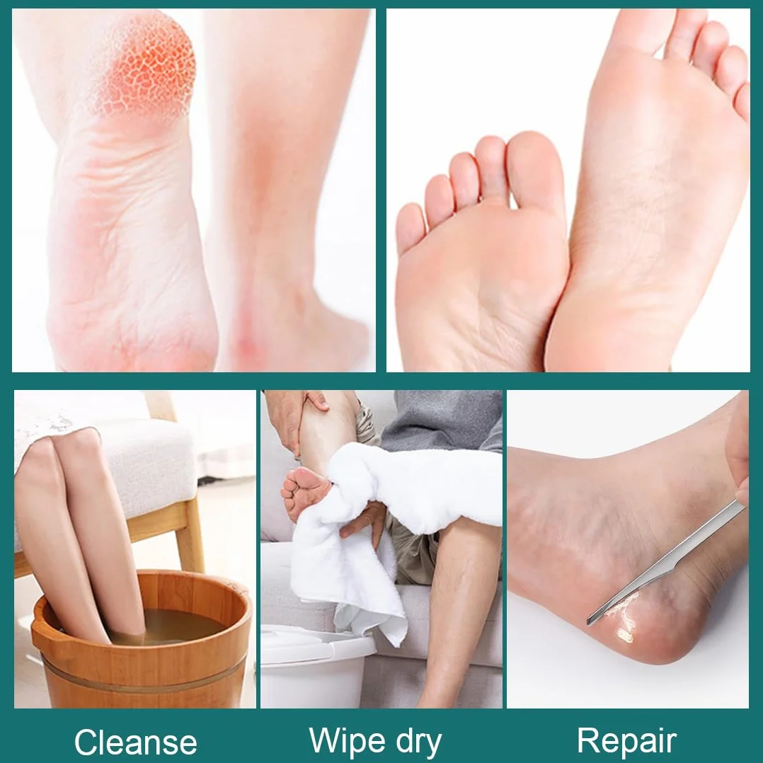 Profesjonalny nóż do pedicure, ostrza, ze stali nierdzewnej, do usuwania zrogowaciałego naskórka, skalpel, ostrze do pielęgnacji stóp, narzędzie do pedicure